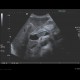 Trombosis of portal vein: US - Ultrasound